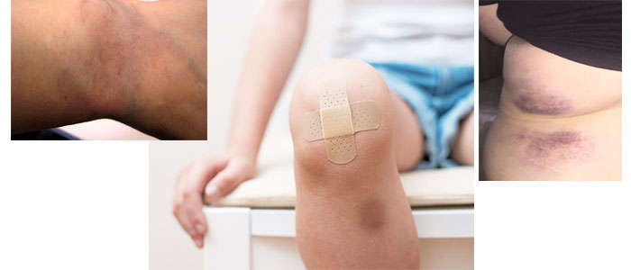 arnica gel boiron indicaciones y modo de empleo